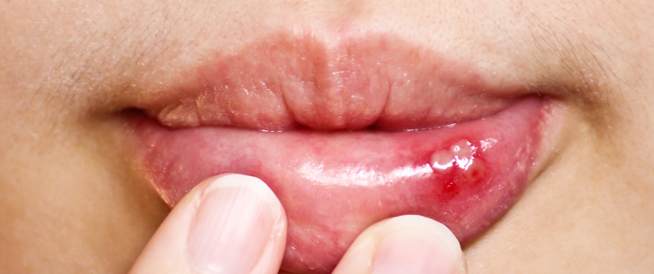 طرق علاج فطريات الفم