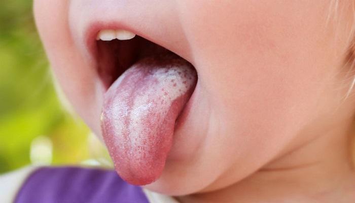 طرق علاج فطريات الفم
