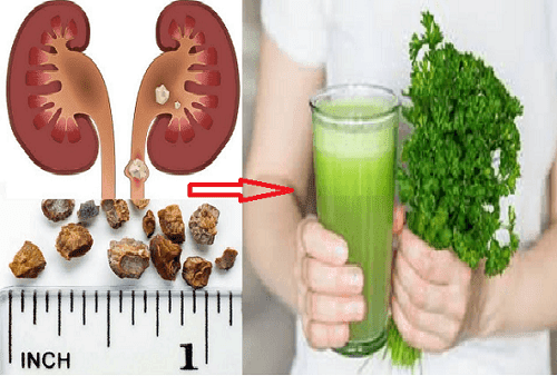 علاج حصى الكلى بالبقدونس