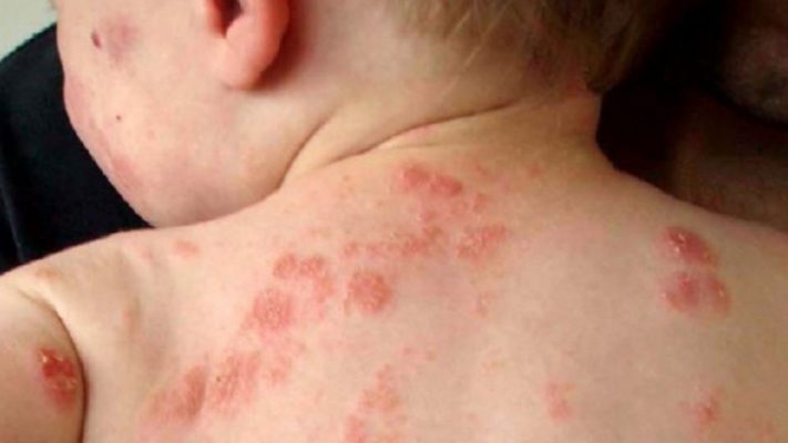 علاج طبيعي للاكزيما عند الأطفال