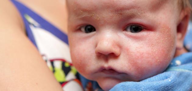 علاج طبيعي للاكزيما عند الأطفال
