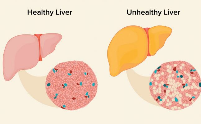 وصفات لعلاج الكبد الدهني