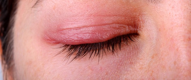 التهاب الجلد حول العين