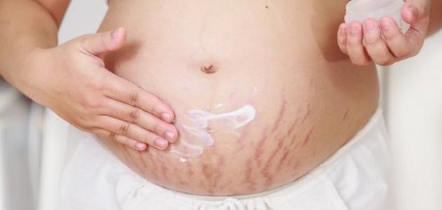 علاج تشققات البطن بعد الولادة