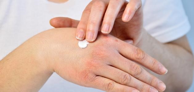علاج حساسية الجلد والهرش