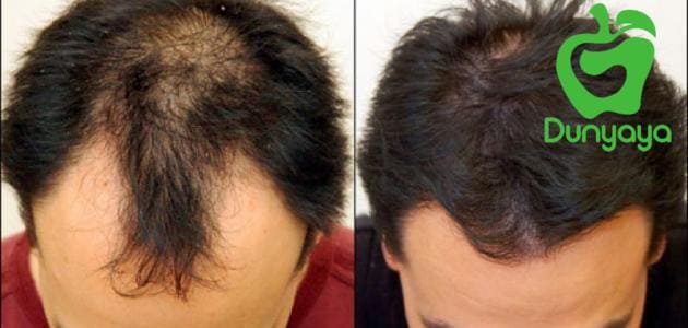 علاج تساقط الشعر للرجال وكيفية تجنب الإصابة بالصلع