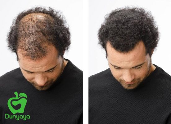 علاج تساقط الشعر للرجال وتكثيفه