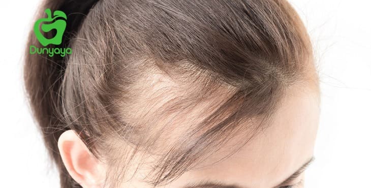 فيتامين لتساقط شعر الأطفال وأسباب تساقط الشعر عند الاطفال