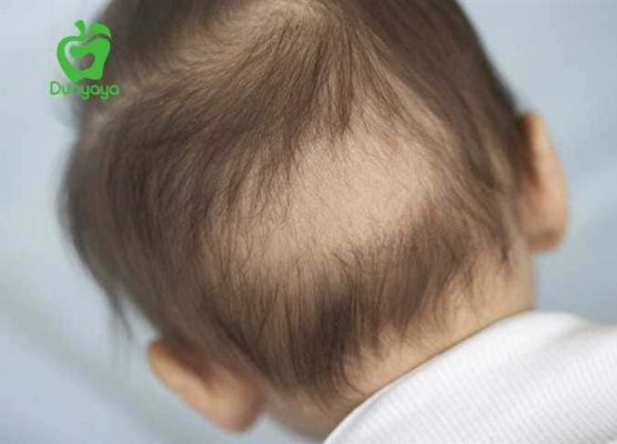 علاج مشكلة تساقط الشعر عند الاطفال