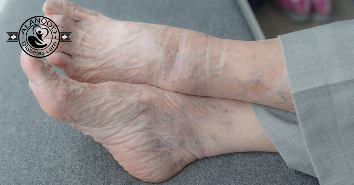 علاج تورم القدمين عند كبار السن